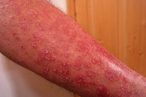 psoriasis-356429_1920